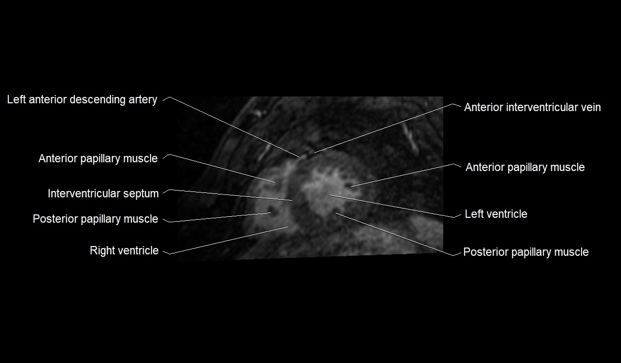 MRI heart and coronary arteries short axis anatomy image 30.webp